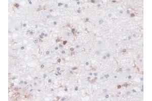 Detection of LCP1 in Human Glioma Tissue using Polyclonal Antibody to L-Plastin (LCP1) (LCP1 antibody  (AA 5-233))