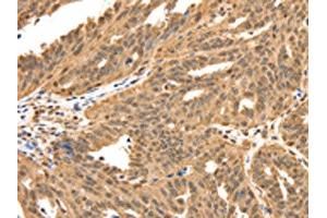 The image on the left is immunohistochemistry of paraffin-embedded Human ovarian cancer tissue using ABIN7192626(SPATA20 Antibody) at dilution 1/70, on the right is treated with synthetic peptide. (SPATA2 antibody)