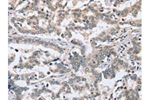 The image on the left is immunohistochemistry of paraffin-embedded Human liver cancer tissue using ABIN7192048(PTGER1 Antibody) at dilution 1/30, on the right is treated with synthetic peptide. (PTGER1 antibody)
