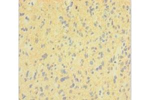 Immunohistochemistry of paraffin-embedded human glioma using ABIN7150825 at dilution of 1:100 (Dynamin 1 antibody  (AA 2-245))