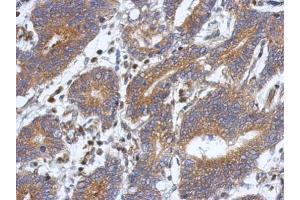 IHC-P Image Immunohistochemical analysis of paraffin-embedded human colon carcinoma, using ATXN10, antibody at 1:500 dilution. (Ataxin 10 antibody)