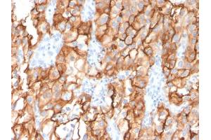 Formalin-fixed, paraffin-embedded human Renal Cell Carcinoma stained with CD10 Mouse Monoclonal Antibody (MME/2579). (MME antibody  (AA 583-740))