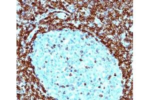 IHC testing of human non-Hodgkin's lymphoma stained with Bcl-2 antibody (124). (Bcl-2 antibody  (AA 41-54))