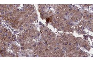 ABIN6272748 at 1/100 staining Human liver cancer tissue by IHC-P.