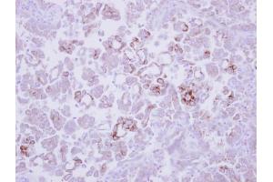 IHC-P Image Immunohistochemical analysis of paraffin-embedded human lung adenocarcinoma, using MMP13, antibody at 1:250 dilution. (MMP13 antibody)