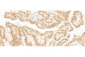 Immunohistochemistry of paraffin-embedded Human thyroid cancer tissue using BICRA Polyclonal Antibody at dilution of 1:40(x200) (BICRA antibody)