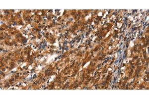 Immunohistochemistry of paraffin-embedded Human gasrtic cancer tissue using CYP2D6 Polyclonal Antibody at dilution 1:40 (CYP2D6 antibody)