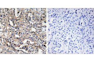 Peptide - +Immunohistochemistry analysis of paraffin-embedded human liver carcinoma tissue using BAX antibody. (BAX antibody)
