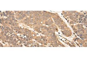 Immunohistochemistry of paraffin-embedded Human thyroid cancer tissue using ZPR1 Polyclonal Antibody at dilution of 1:40(x200) (ZNF259 antibody)