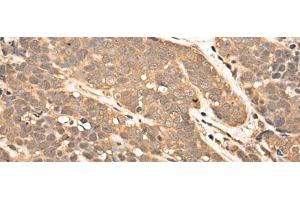 Immunohistochemistry of paraffin-embedded Human thyroid cancer tissue using ZPR1 Polyclonal Antibody at dilution of 1:40(x200)