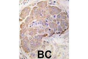 Formalin-fixed and paraffin-embedded human breast carcinoma tissue reacted with HSPB1 Antibody (S82) (ABIN391299 and ABIN2841335) , which was peroxidase-conjugated to the secondary antibody, followed by DAB staining.