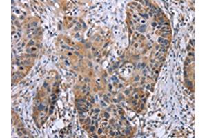 The image on the left is immunohistochemistry of paraffin-embedded Human esophagus cancer tissue using ABIN7130502(OPTN Antibody) at dilution 1/25, on the right is treated with fusion protein. (OPTN antibody)