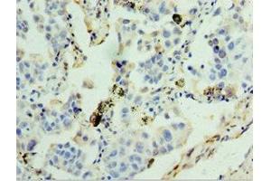 Immunohistochemistry of paraffin-embedded human lung cancer using ABIN7154097 at dilution of 1:100 (GSTA4 antibody  (AA 93-222))
