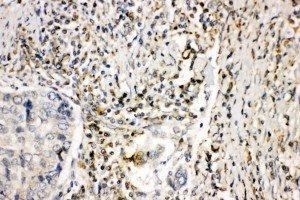 Anti-NOX1 antibody, IHC(P) IHC(P): Human Lung Cancer Tissue (NOX1 antibody  (Middle Region))