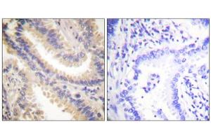 Immunohistochemistry analysis of paraffin-embedded human lung carcinoma tissue using TIMP4 antibody. (TIMP4 antibody  (C-Term))