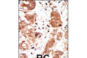 Formalin-fixed and paraffin-embedded human cancer tissue reacted with the primary antibody, which was peroxidase-conjugated to the secondary antibody, followed by DAB staining. (PIM1 antibody  (C-Term))