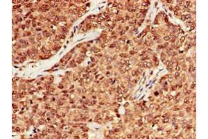 Immunohistochemistry of paraffin-embedded human ovarian cancer using ABIN7150624 at dilution of 1:100 (Mre11 antibody  (AA 1-205))