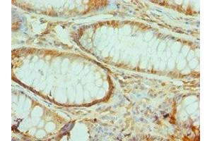 Immunohistochemistry of paraffin-embedded human colon cancer using ABIN7172290 at dilution of 1:100 (TIRAP antibody  (AA 1-221))