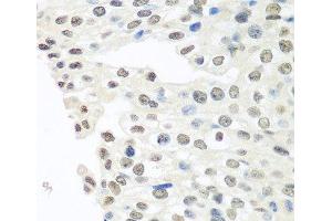 Immunohistochemistry of paraffin-embedded Human prostate cancer using TARDBP Polyclonal Antibody at dilution of 1:100 (40x lens). (TARDBP antibody)