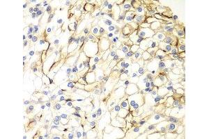 Immunohistochemistry of paraffin-embedded Human kidney cancer using VANGL2 Polyclonal Antibody at dilution of 1:100 (40x lens). (VANGL2 antibody)