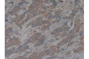 IHC-P analysis of Human Breast Cancer Tissue, with DAB staining. (CX3CL1 antibody  (AA 25-332))