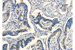ABIN6263397 and ABIN6278053 at 1/100 staining Human prostate cancer by IHC-P. (Mesothelin antibody  (C-Term))