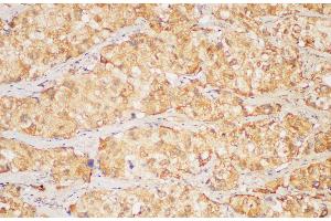 Immunohistochemistry of paraffin-embedded Human liver cancer using FGB Polycloanl Antibody at dilution of 1:200 (Fibrinogen beta Chain antibody)