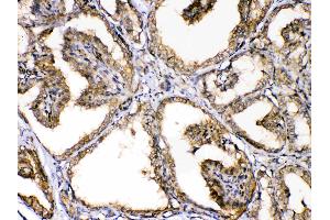 GAPDH was detected in paraffin-embedded sections of human thyroid cancer tissues using rabbit anti- GAPDH Antigen Affinity purified polyclonal antibody (Catalog # ) at 1 µg/mL.