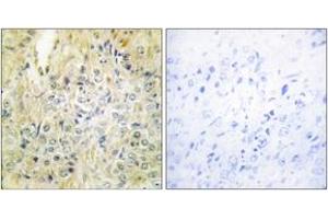 Immunohistochemistry analysis of paraffin-embedded human prostate carcinoma tissue, using DLEC1 Antibody. (DLEC1 antibody  (AA 1-50))
