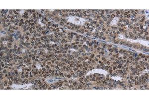Immunohistochemistry of paraffin-embedded Human ovarian cancer tissue using MAGEC1 Polyclonal Antibody at dilution 1:30 (MAGEC1 antibody)