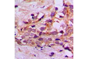 Immunohistochemical analysis of DYNLL2 staining in human breast cancer formalin fixed paraffin embedded tissue section. (DYNLL2 antibody  (N-Term))