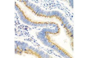 Immunohistochemistry of paraffin-embedded human colon carcinoma using UBIAD1 antibody at dilution of 1:100 (40x lens). (UBIAD1 antibody)