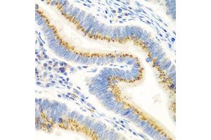 Immunohistochemistry of paraffin-embedded human colon carcinoma using UBIAD1 antibody at dilution of 1:100 (40x lens).