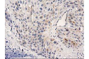 Immunohistochemical staining of paraffin-embedded Carcinoma of Human bladder tissue using anti-PLEKHA3 mouse monoclonal antibody.