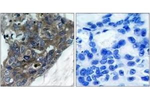 Immunohistochemistry analysis of paraffin-embedded human breast carcinoma tissue, using ASK1 (Ab-966) Antibody. (ASK1 antibody  (AA 932-981))