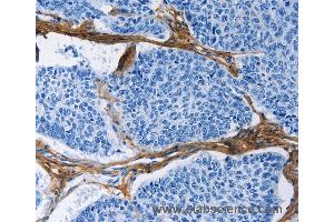 Immunohistochemistry of Human prostate cancer using COL3A1 Polyclonal Antibody at dilution of 1:60 (COL3A1 antibody)