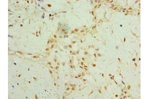 Immunohistochemistry of paraffin-embedded human breast cancer using ABIN7159637 at dilution of 1:100 (TET2 antibody  (AA 1833-2002))