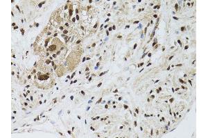 Immunohistochemistry of paraffin-embedded human colon carcinoma using STK11 antibody. (LKB1 antibody  (AA 134-433))
