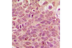 Immunohistochemical analysis of RPL36 staining in human breast cancer formalin fixed paraffin embedded tissue section. (RPL36 antibody  (Center))