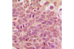 Immunohistochemical analysis of RPL36 staining in human breast cancer formalin fixed paraffin embedded tissue section.
