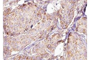 ABIN6277590 at 1/100 staining Human breast cancer tissue by IHC-P. (HSD17B10 antibody  (Internal Region))