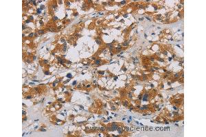 Immunohistochemistry of Human thyroid cancer using CNDP1 Polyclonal Antibody at dilution of 1:30 (CNDP1 antibody)