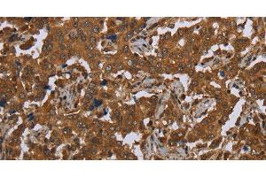 Immunohistochemistry of paraffin-embedded Human liver cancer tissue using SCGB1D2 Polyclonal Antibody at dilution 1:40 (SCGB1D2 antibody)