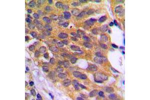 Immunohistochemical analysis of EEF2K (pS366) staining in human prostate cancer formalin fixed paraffin embedded tissue section. (EEF2K antibody  (pSer366))