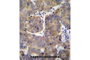 EIF3H Antibody (N-term) immunohistochemistry analysis in formalin fixed and paraffin embedded human hepatocarcinoma followed by peroxidase conjugation of the secondary antibody and DAB staining.