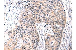 The image on the left is immunohistochemistry of paraffin-embedded Human esophagus cancer tissue using ABIN7192749(TCERG1L Antibody) at dilution 1/30, on the right is treated with synthetic peptide. (TCERG1L antibody)