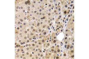 Immunohistochemistry of paraffin-embedded human liver cancer using MAGE-1/MA antibody (ABIN6132325, ABIN6143435, ABIN6143436 and ABIN6221133) at dilution of 1:200 (40x lens). (MAGEA1 antibody  (AA 1-309))