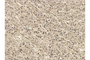 SAP62 Mouse Monoclonal Antibody at 1/100 staining human gastric cancer by IHC-P.
