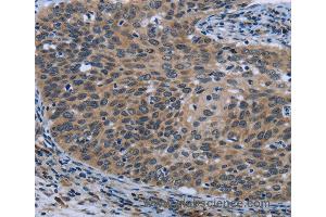 Immunohistochemistry of Human cervical cancer using AVEN Polyclonal Antibody at dilution of 1:30 (AVEN antibody)