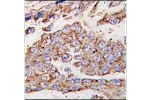 Formalin-fixed and paraffin-embedded human lung carcinoma tissue reacted with CD107a / LAMP1 Antibody (N-term) followed which was peroxidase-conjugated to the secondary antibody, followed by DAB staining. (LAMP1 antibody  (N-Term))